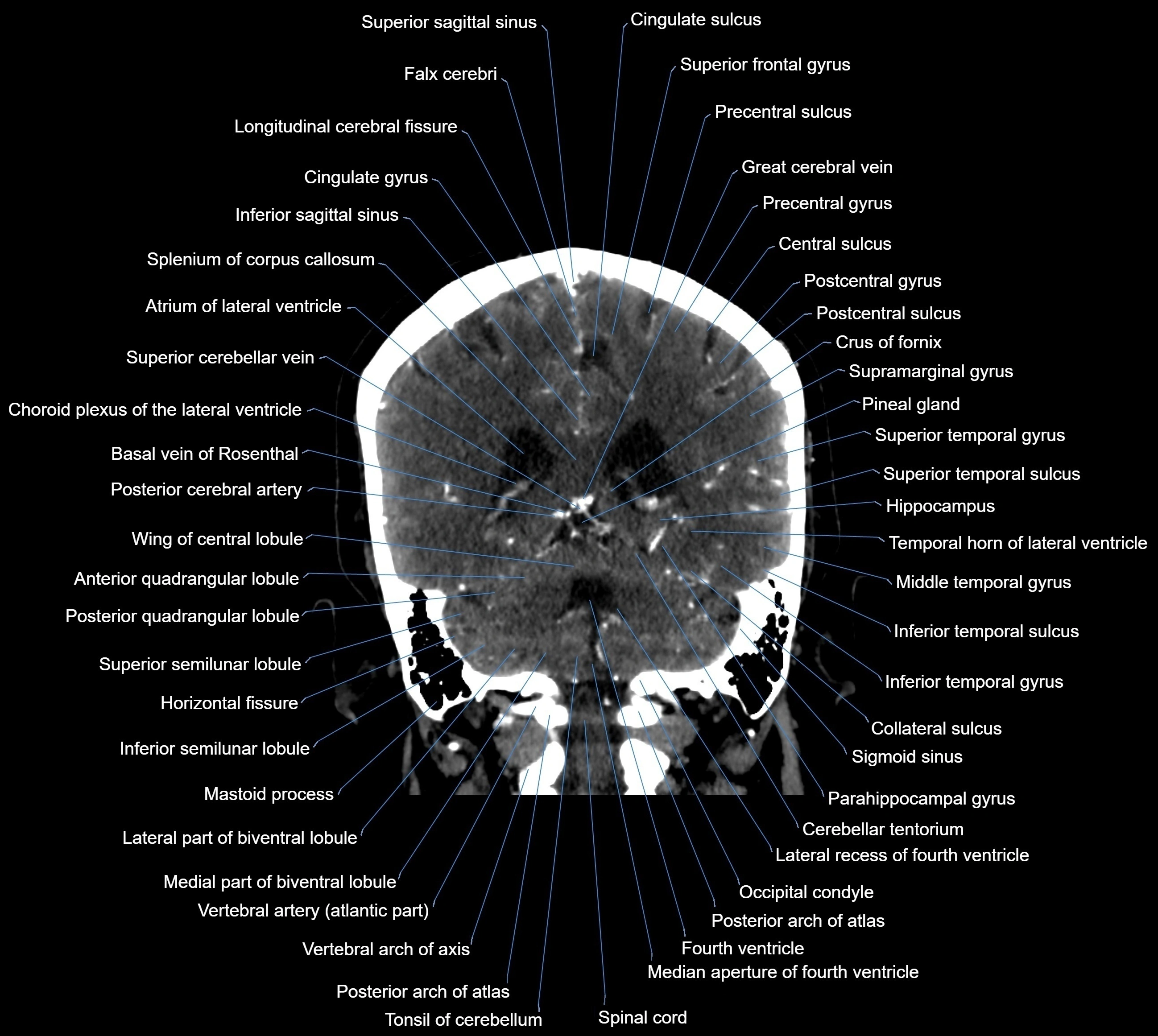 CT Brain coronal cross sectional radiology anatomy image  -img-00001-031.webp